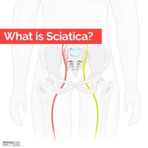 What is Sciatica