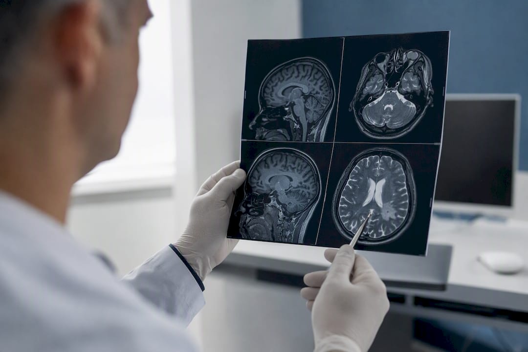 Hands holding brain MRI scan showing FTD features