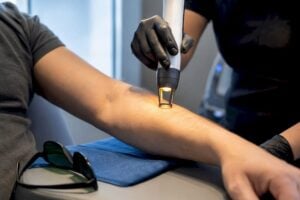 Clinician applying therapeutic laser to forearm